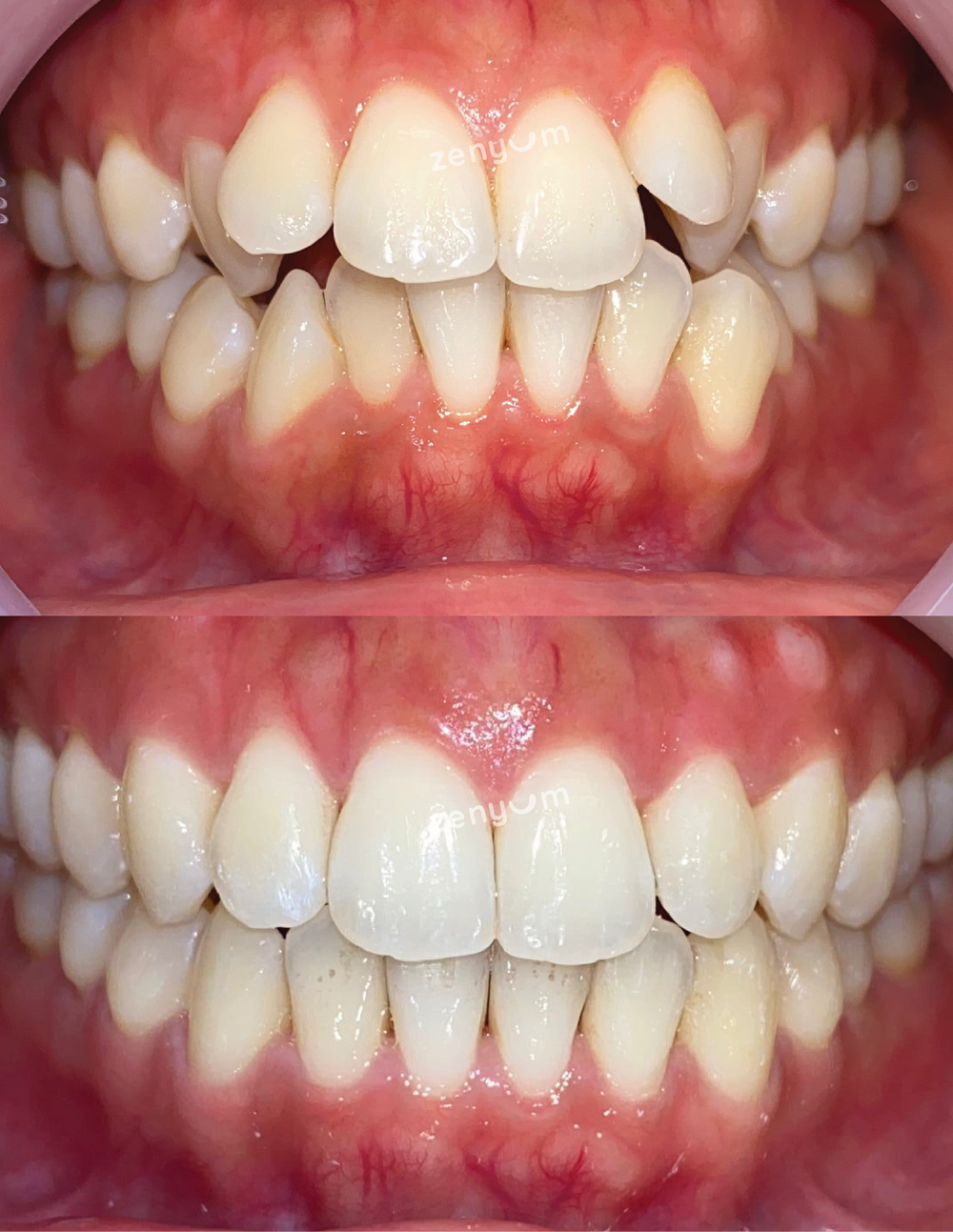 ZenyumClear Plus 牙齒矯正前後對比