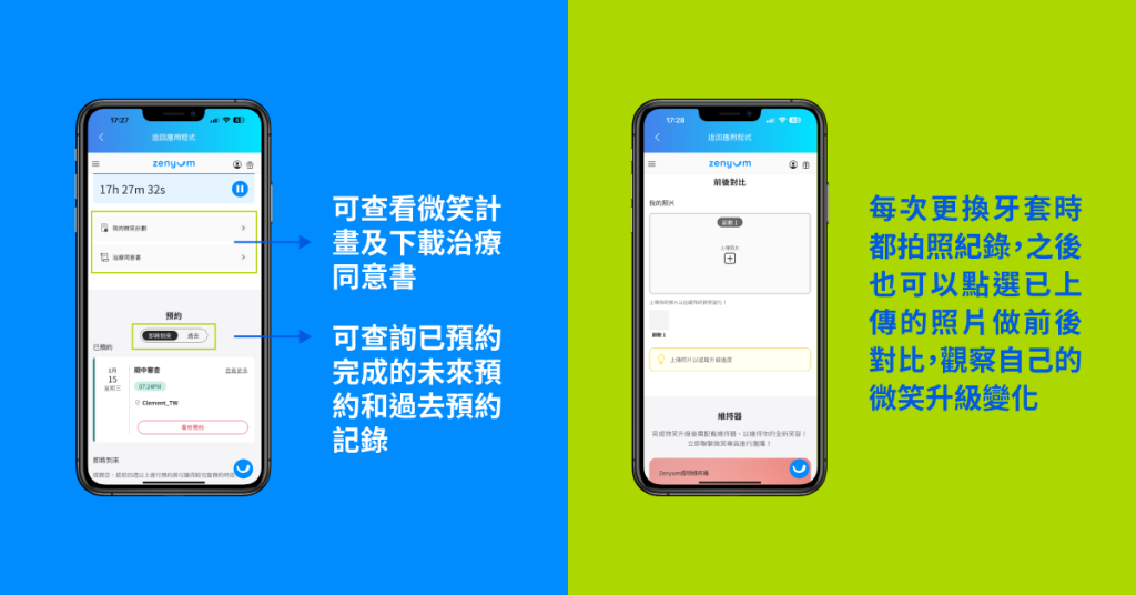 Zenyum App 官方介面：預約紀錄、療程計劃及牙齒前後比較